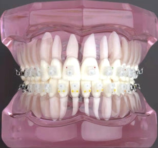 Model Gigi Dengan Bracket Ortho 3B ORTHO