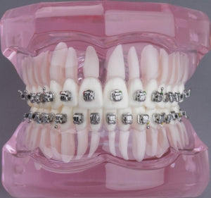 Model Gigi Dengan Bracket Ortho 3B ORTHO